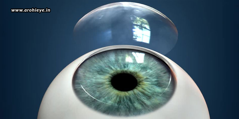 Cornea Transplant – Why And How?