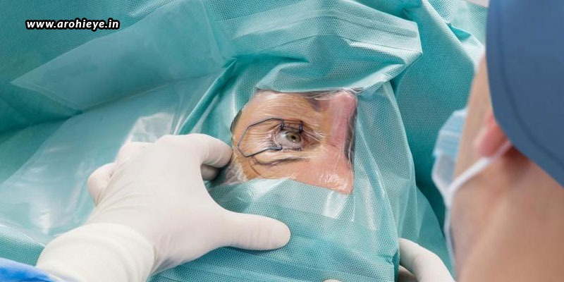 Preparing For Cataract Surgery