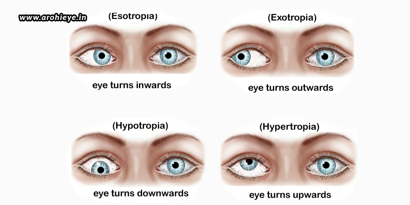 Squint Surgery for different types of squint eyes