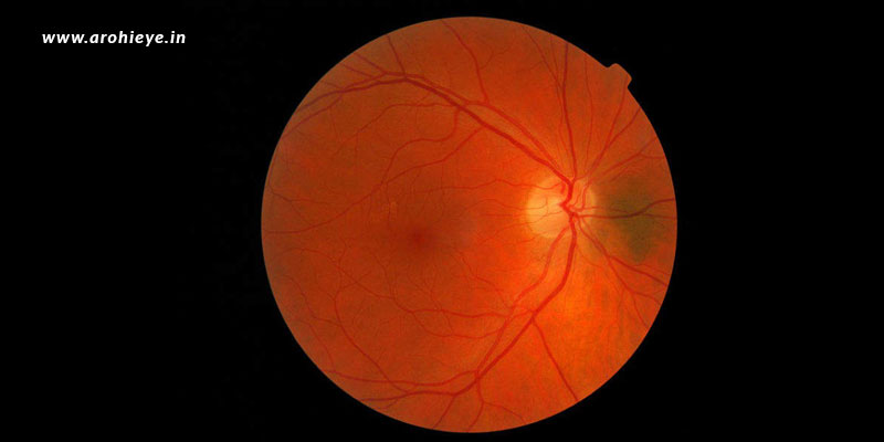 What are retinal problems?