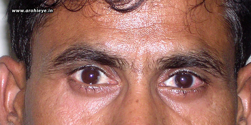 Cost-Of-Squint-Eye-Surgery-In-India