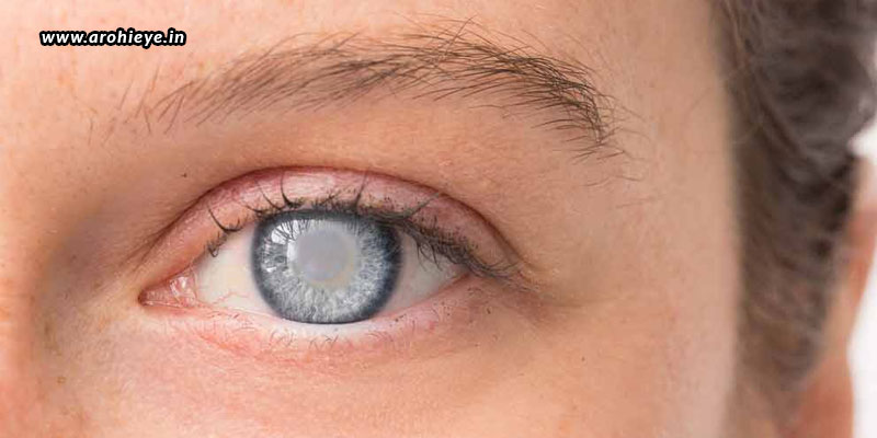 cataract surgery after lasik eye surgery