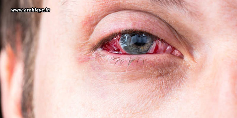 Can eyes spread the coronavirus?