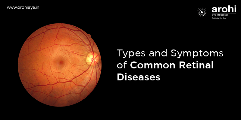 Types and Symptoms of Common Retinal Diseases