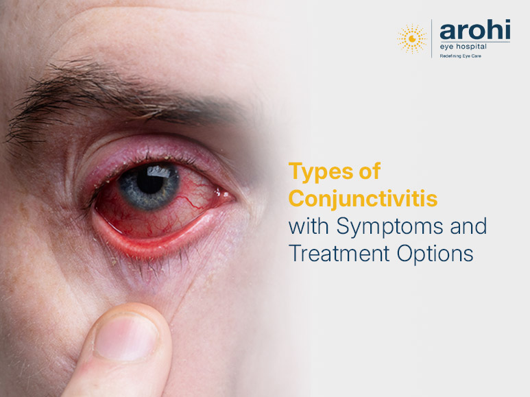 Types of Conjunctivitis