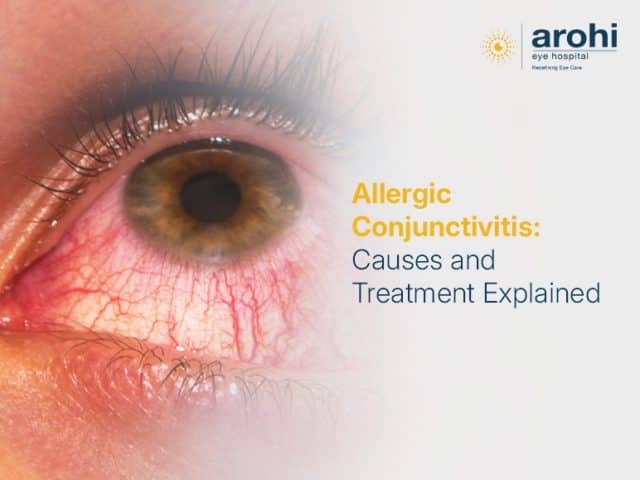 Allergic Conjunctivitis: Causes and Treatment Explained