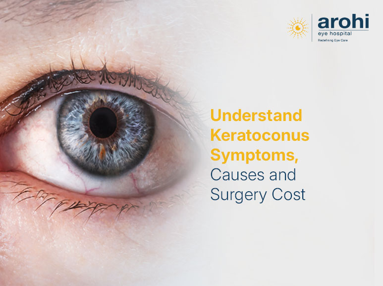 symptoms of keratoconus