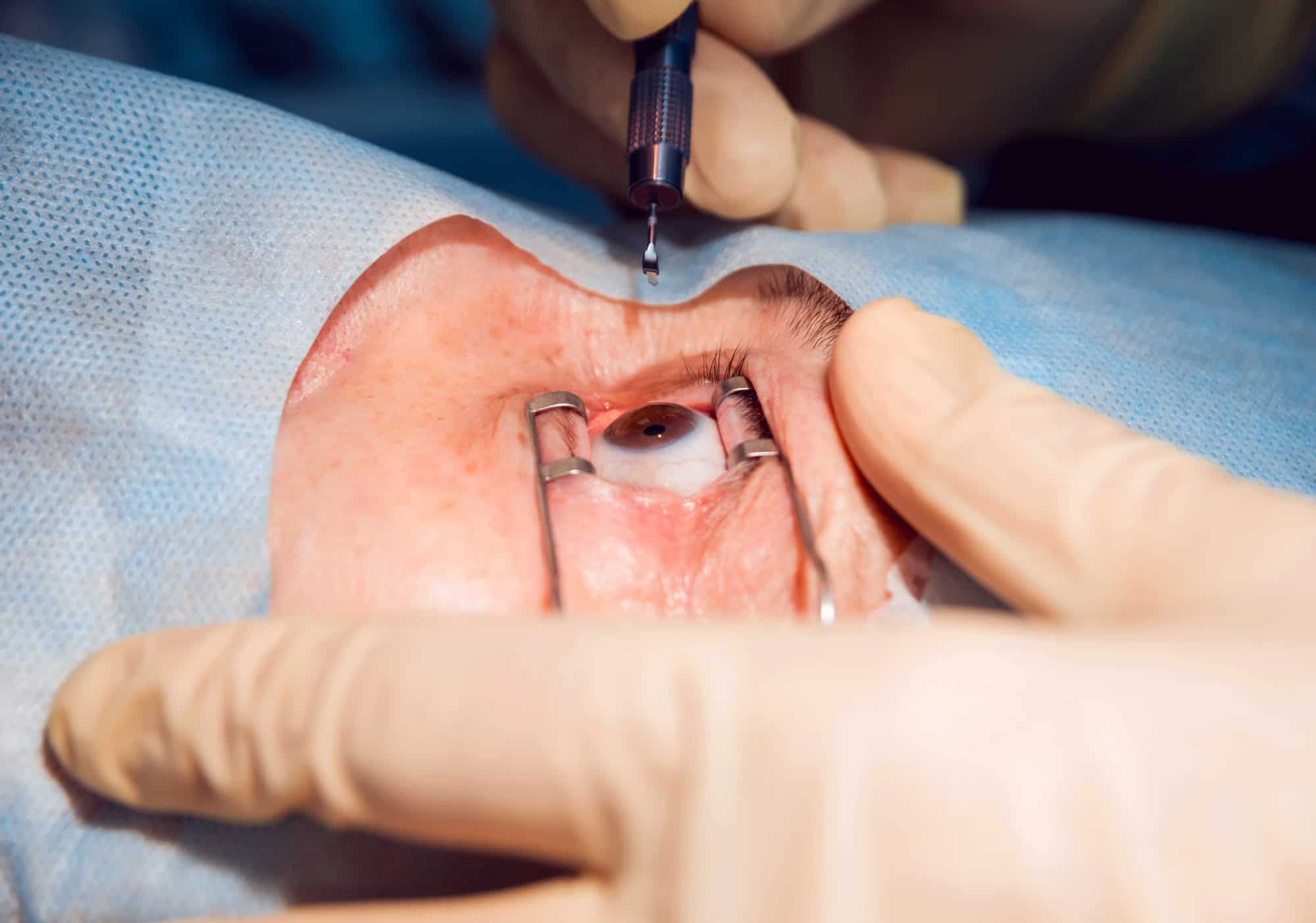 best lasik treatment in india