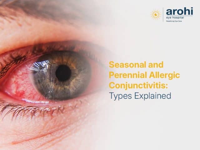 Seasonal and Perennial Allergic Conjunctivitis: Types Explained