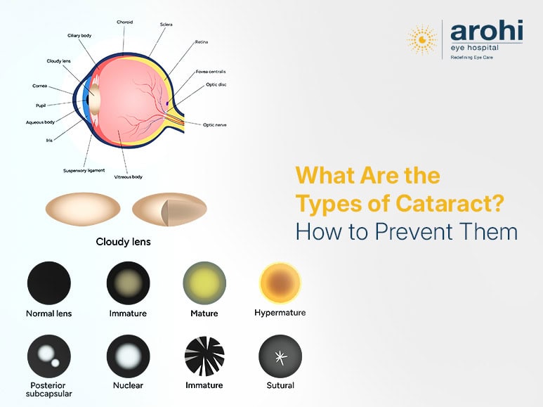 Cataract treatment in Mumbai
