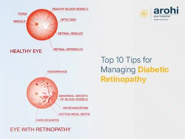 Top 10 Tips for Managing Diabetic Retinopathy
