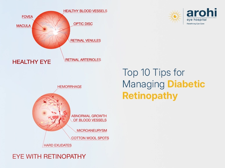 diabetic retinopathy symptoms