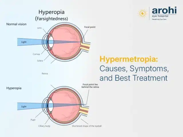 Hypermetropia: Causes, Symptoms, and Best Treatment