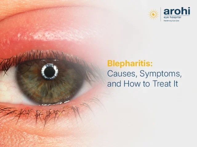 Blepharitis: Causes, Symptoms, and How to Treat It