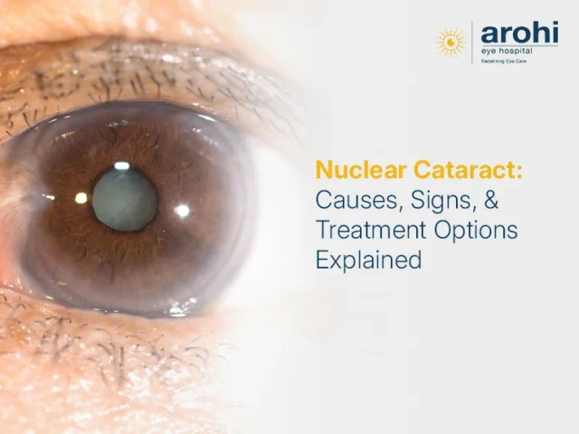 Nuclear Cataract: Causes, Signs, & Treatment Options Explained