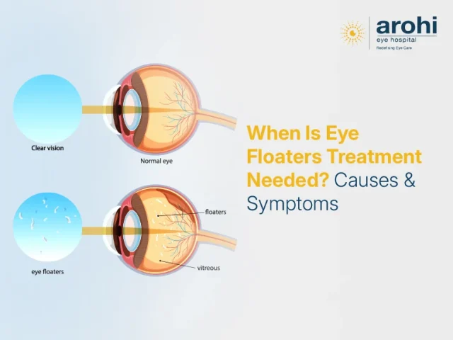 When Is Eye Floaters Treatment Needed? Causes & Symptoms